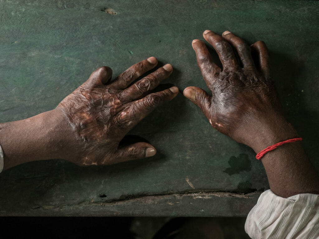 Hands of a burned shipbreaking worker, photography Studio Fasching, Reinhard Fasching Photographer